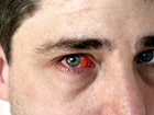 Mann mit rotem Auge
